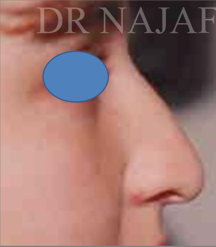 Rhinoplasty before — Dr. Hossein Najafi