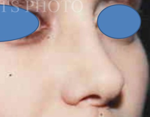 Rhinoplasty after — Dr. Hossein Najafi
