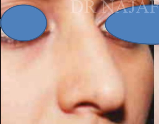 Rhinoplasty before — Dr. Hossein Najafi