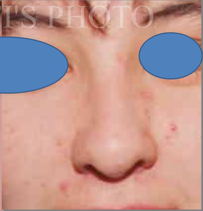 Rhinoplasty after — Dr. Hossein Najafi