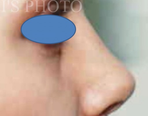 Rhinoplasty after — Dr. Hossein Najafi