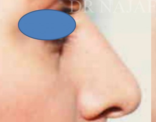 Rhinoplasty before — Dr. Hossein Najafi