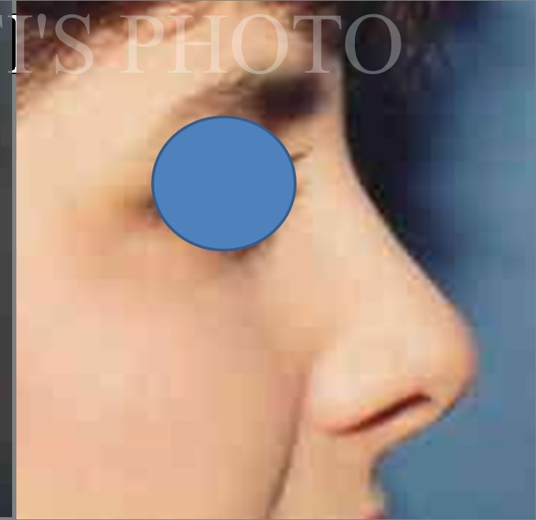 Rhinoplasty after — Dr. Hossein Najafi
