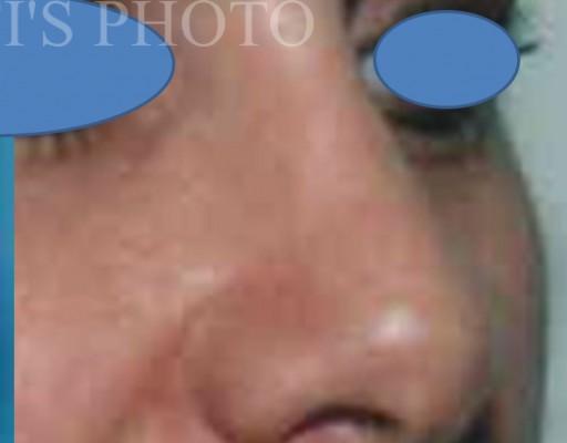 Rhinoplasty after — Dr. Hossein Najafi
