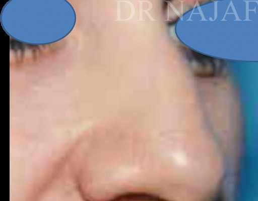 Rhinoplasty before — Dr. Hossein Najafi