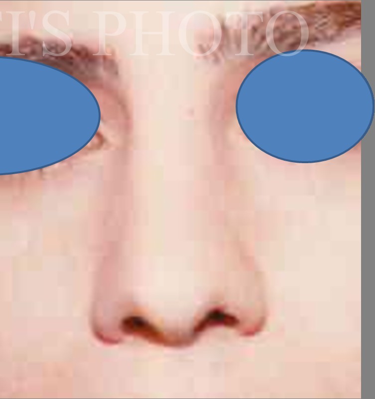 Rhinoplasty after — Dr. Hossein Najafi