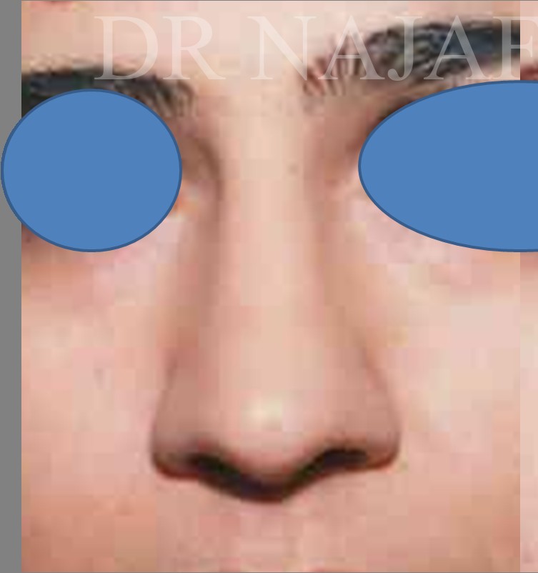 Rhinoplasty before — Dr. Hossein Najafi