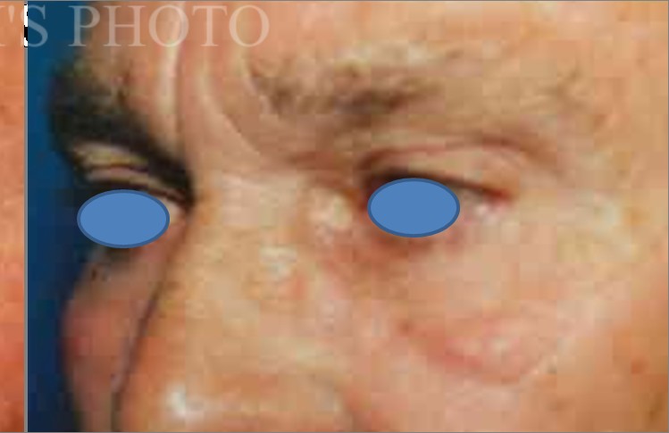 Blepharoplasty before and after - after