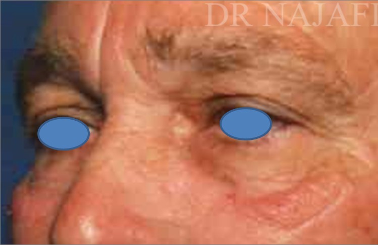 Blepharoplasty before and after - before