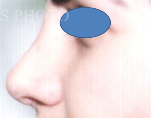 Rhinoplasty after — Dr. Hossein Najafi