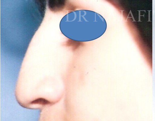 Rhinoplasty before — Dr. Hossein Najafi