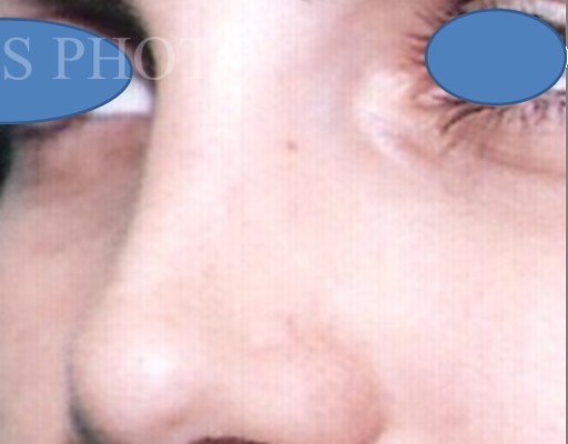Rhinoplasty after — Dr. Hossein Najafi