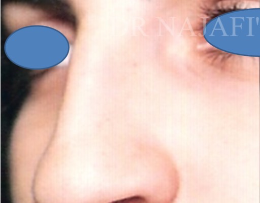 Rhinoplasty before — Dr. Hossein Najafi