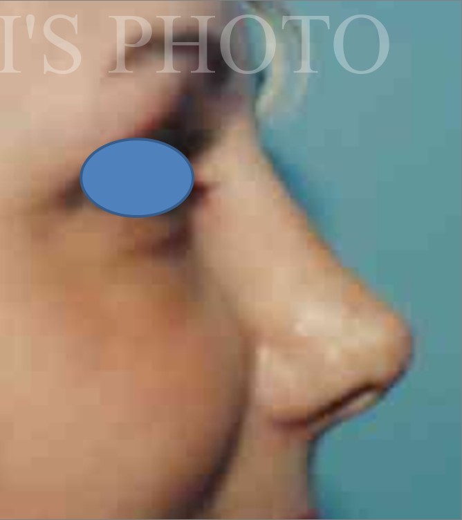 Rhinoplasty after — Dr. Hossein Najafi