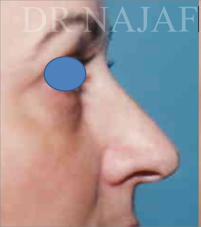 Rhinoplasty before — Dr. Hossein Najafi
