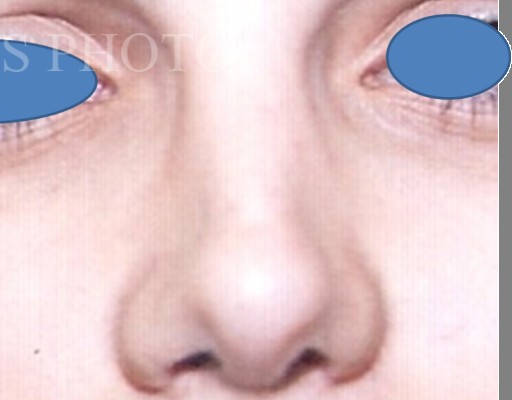 Rhinoplasty after — Dr. Hossein Najafi