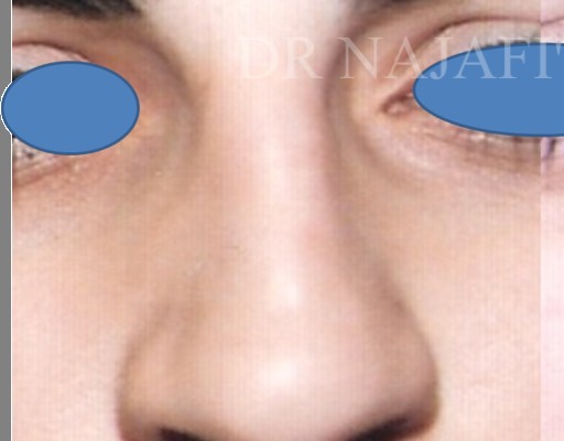 Rhinoplasty before — Dr. Hossein Najafi