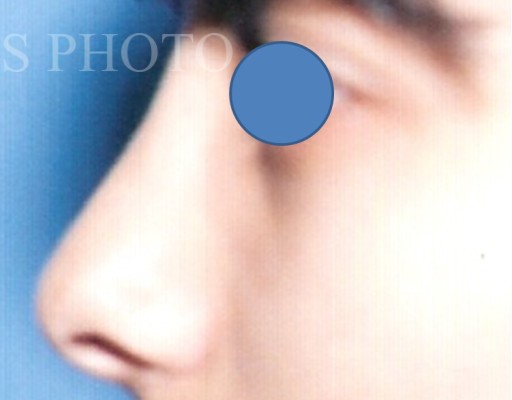 Rhinoplasty after — Dr. Hossein Najafi