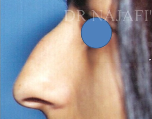 Rhinoplasty before — Dr. Hossein Najafi