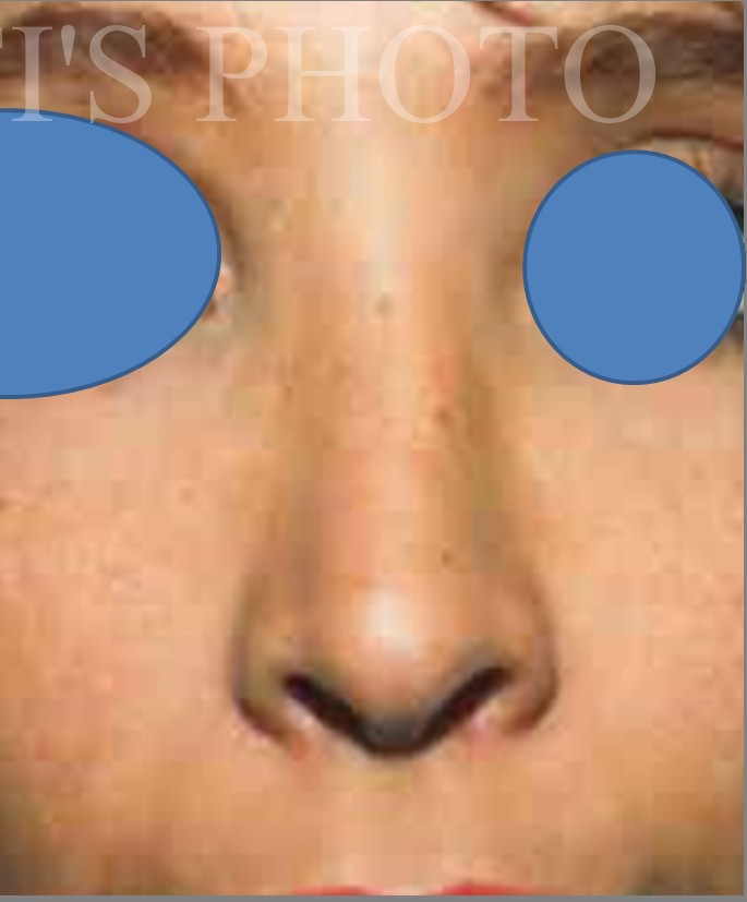 Rhinoplasty after — Dr. Hossein Najafi