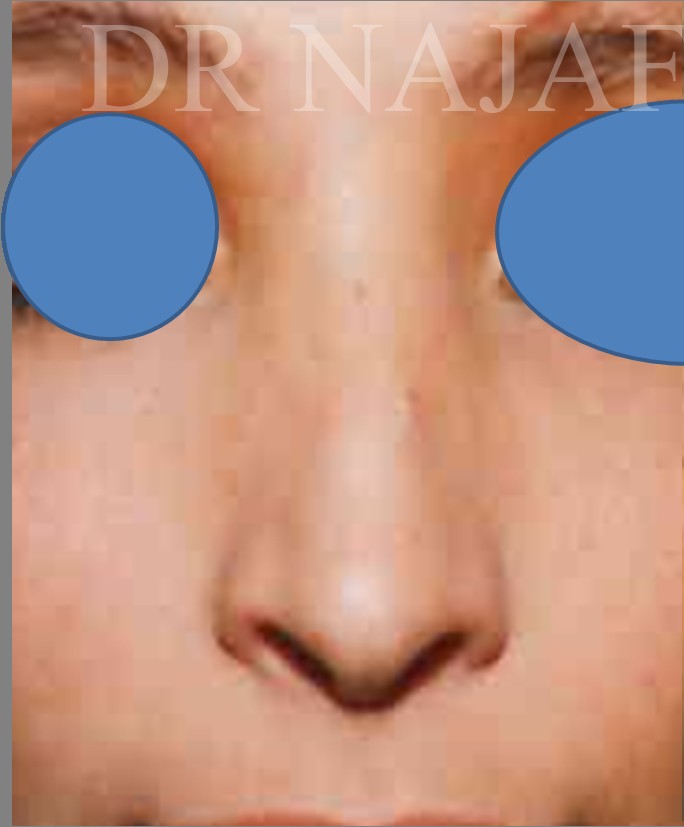 Rhinoplasty before — Dr. Hossein Najafi