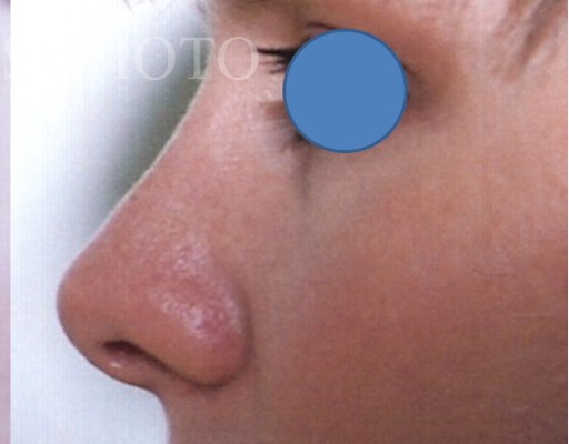 Rhinoplasty after — Dr. Hossein Najafi