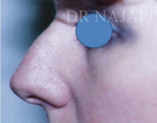 Rhinoplasty before — Dr. Hossein Najafi