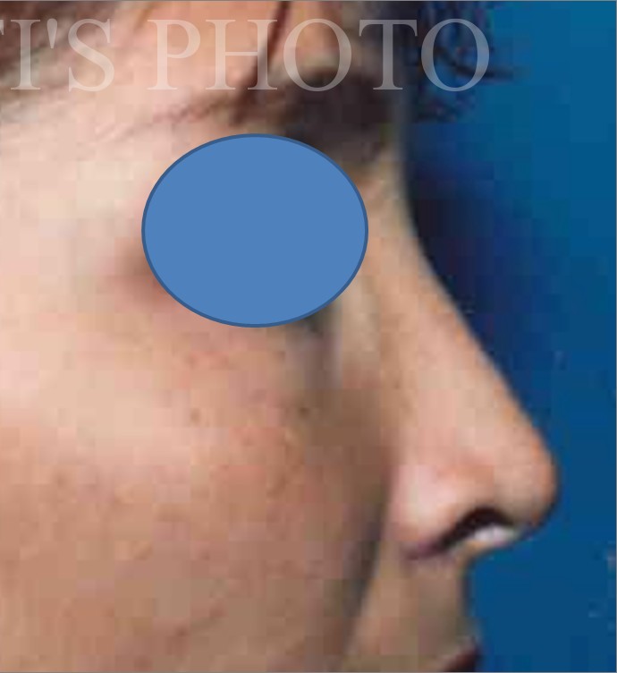 Rhinoplasty after — Dr. Hossein Najafi