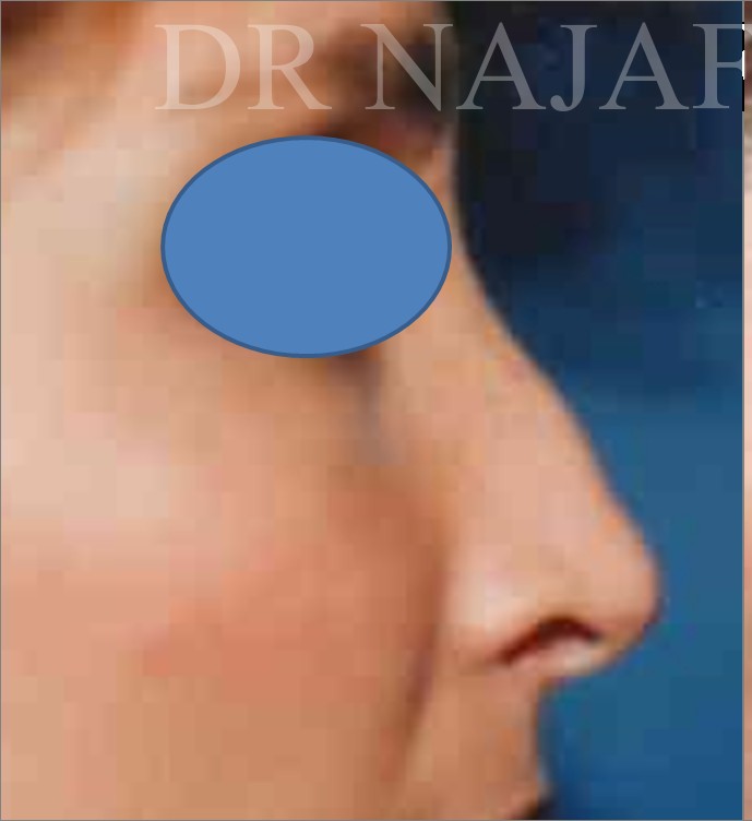 Rhinoplasty before — Dr. Hossein Najafi