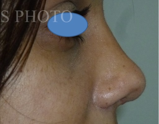 Rhinoplasty after — Dr. Hossein Najafi