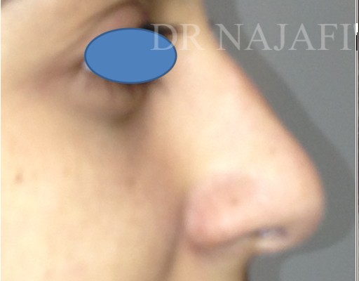 Rhinoplasty before — Dr. Hossein Najafi