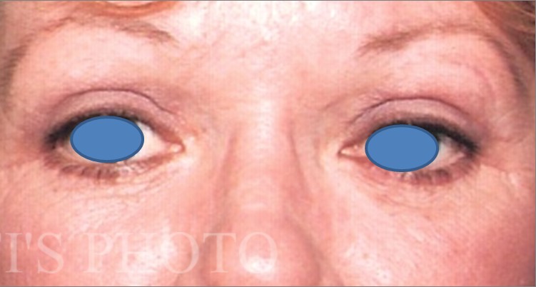 Blepharoplasty before and after - after