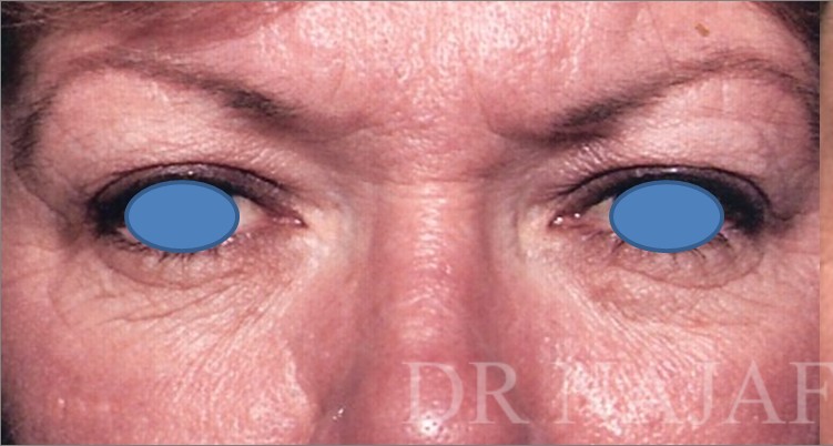 Blepharoplasty before and after - before