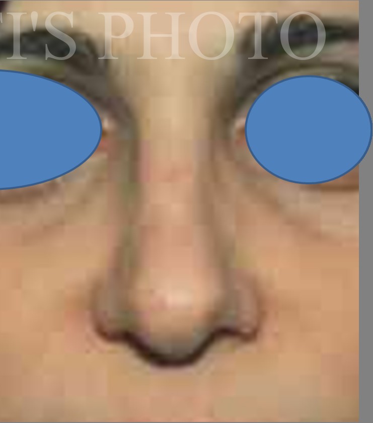 Rhinoplasty after — Dr. Hossein Najafi
