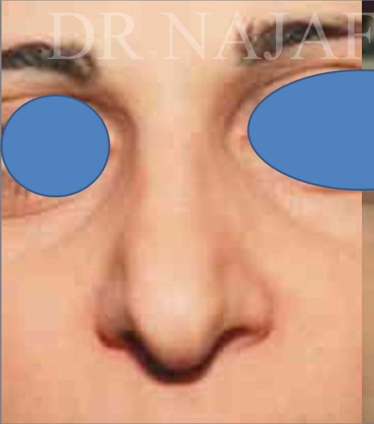 Rhinoplasty before — Dr. Hossein Najafi