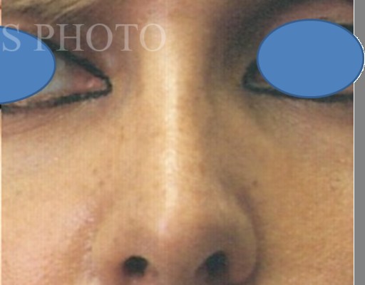 Rhinoplasty after — Dr. Hossein Najafi