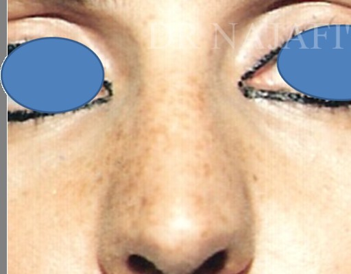 Rhinoplasty before — Dr. Hossein Najafi