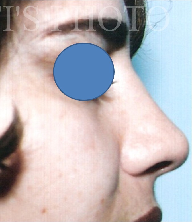 Rhinoplasty after — Dr. Hossein Najafi