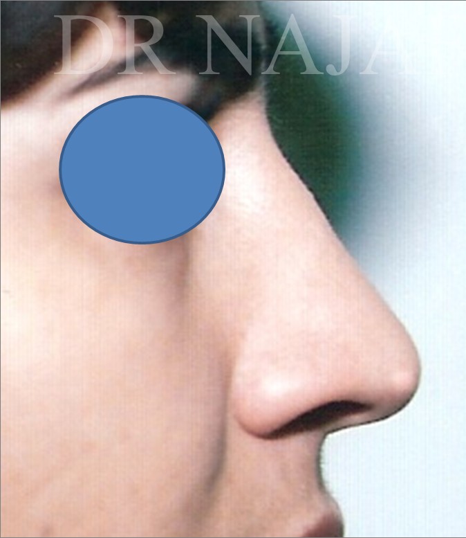 Rhinoplasty before — Dr. Hossein Najafi