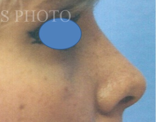 Rhinoplasty before and after - after