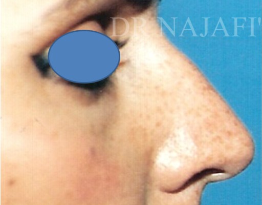 Rhinoplasty before and after - before