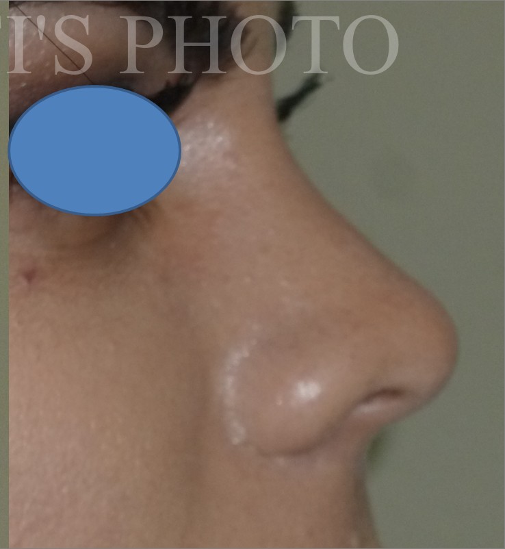 Rhinoplasty before and after - after