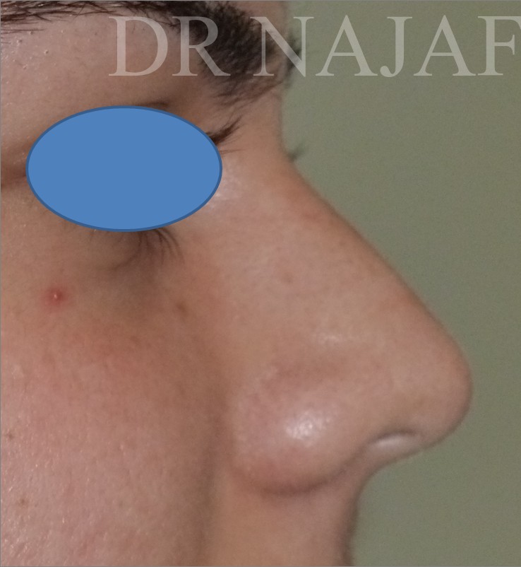 Rhinoplasty before and after - before