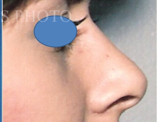 Rhinoplasty before and after - after