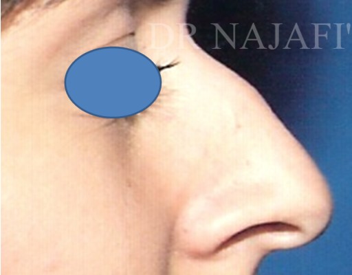 Rhinoplasty before and after - before