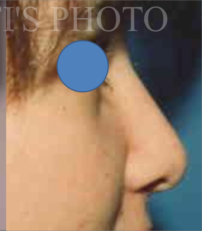 Rhinoplasty before and after - after