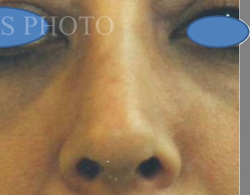 Rhinoplasty before and after - after