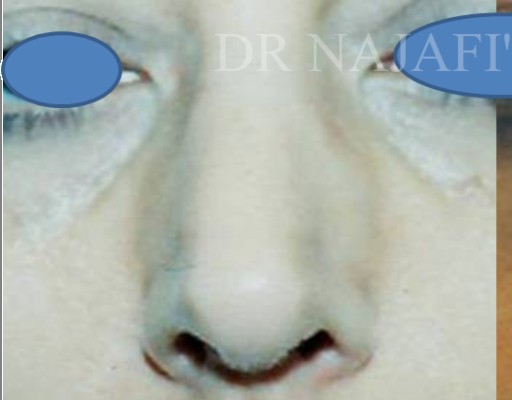 Rhinoplasty before and after - before