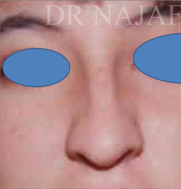 Rhinoplasty before and after - before