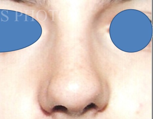 Rhinoplasty before and after - after